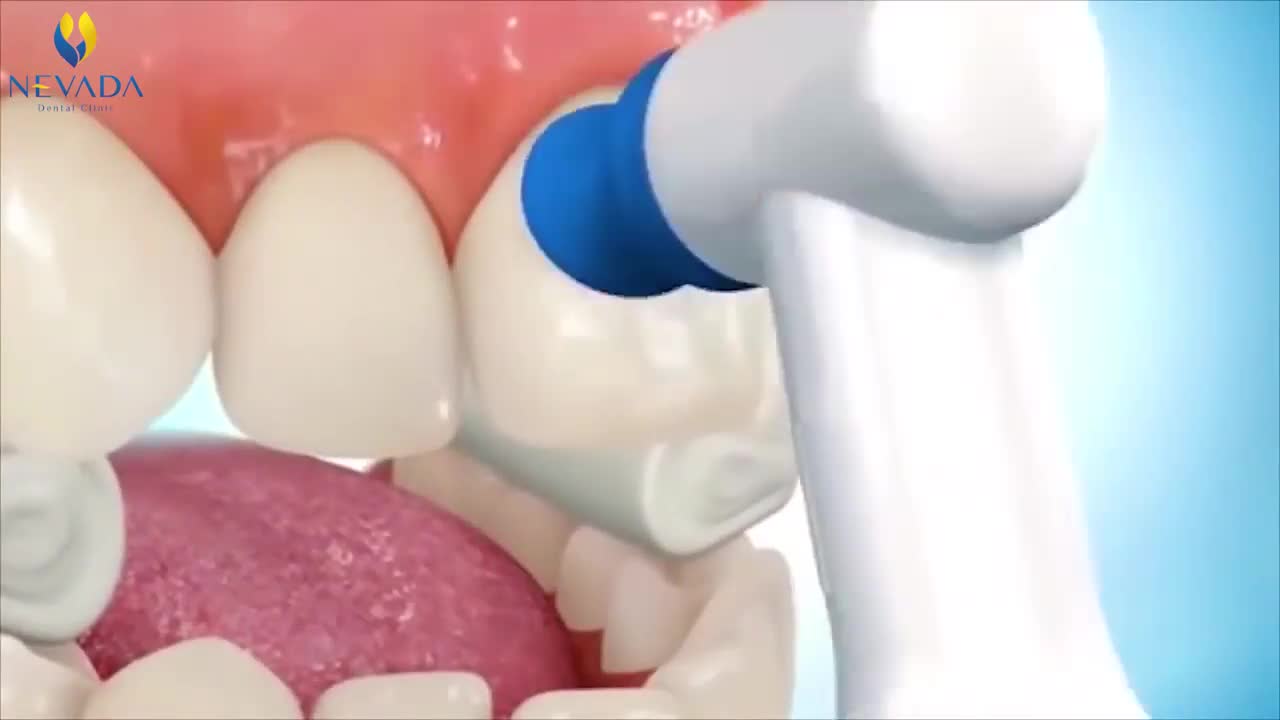 Xem ngay video niềng răng thực tế để hiểu rõ hơn về quá trình niềng răng