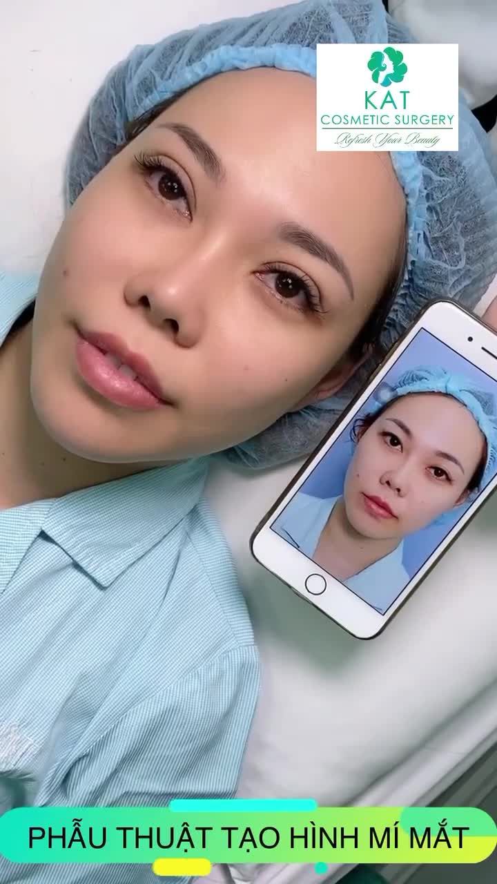 Đây là hình ảnh thực tế của khách hàng nhà KAT ngay sau khi tạo hình mắt. Đôi mắt long lanh, rạng ngời thế này đã đủ thuyết phục bạn chưa?