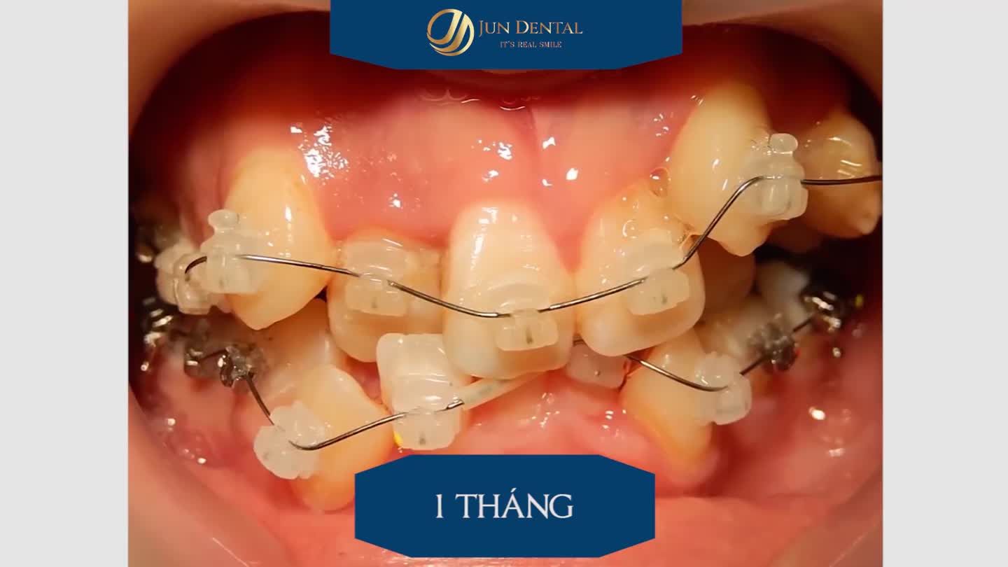 HÌNH ẢNH THỰC TẾ KẾT QUẢ DỊCH CHUYỂN RĂNG CỦA KHÁCH HÀNG CHỈNH NHA TẠI JUN DENTAL