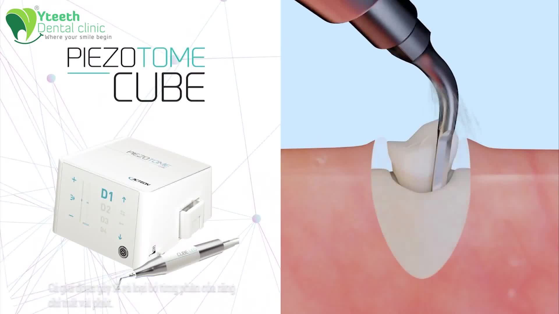 NHỔ RĂNG KHÔN KHÔNG ĐAU CÙNG SÓNG SIÊU ÂM PIEZOTOME