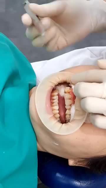 NIỀNG RĂNG gắn mắc cài sứ tại Shinbi