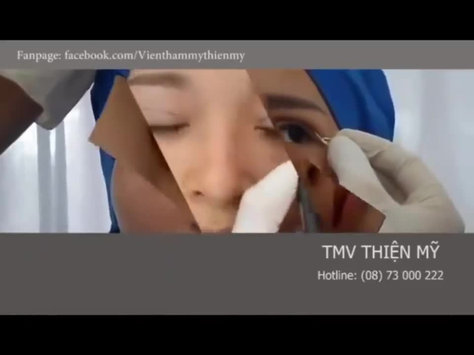 QUY TRÌNH BẤM MÍ ĐA ĐIỂM VĨNH VIỄN TẠI THIỆN MỸ