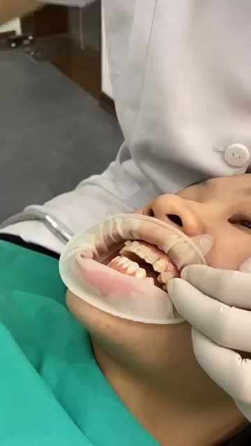 1 ca gắn MẮC CÀI SỨ cuối ngày tại Shinbi