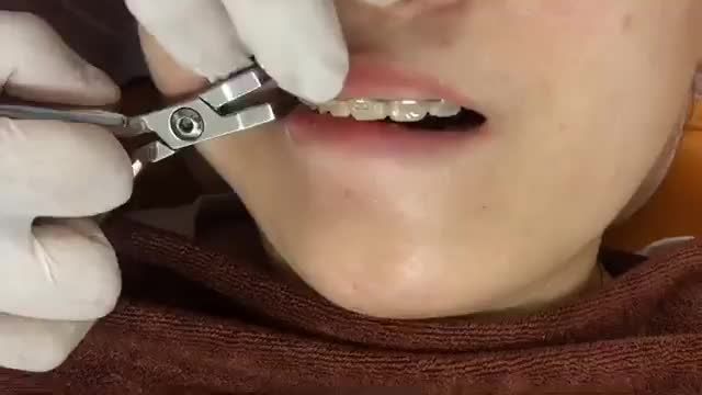 BUNG LỤA CHO KHÁCH HÀNG RĂNG HÔ KHẤP KHỂNH