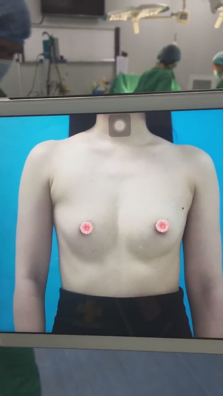 Kết quả ngay sau khi nâng ngực của chị khách hàng qua bàn tay vàng của Ts.Bs Mai Mạnh Tuấn và ekip Viện thẩm mỹ Hà Nội đây nhé chị em!