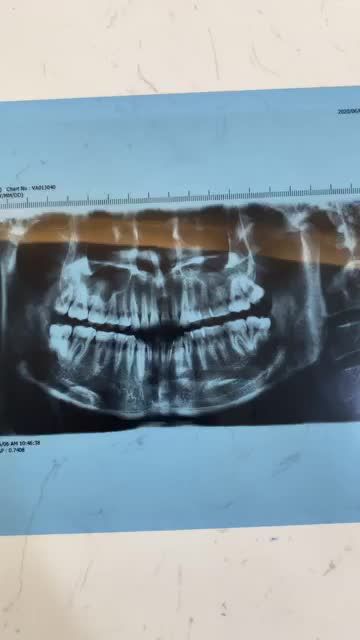 Loại bỏ 4 răng khôn trong 1 lần hẹn với Nha Khoa Delia