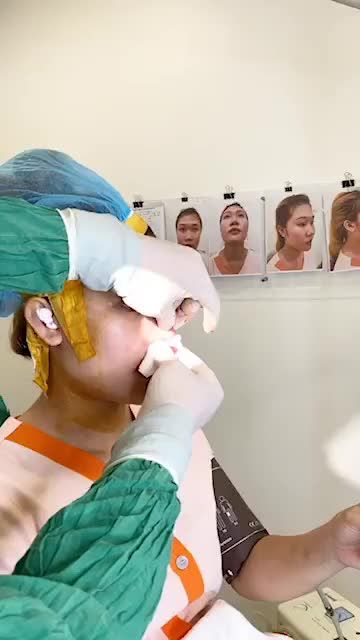 MŨI NGẮN HẾCH - ĐẦU MŨI TO CẢI THIỆN HIỆU QUẢ SAU NÂNG MŨI CẤU TRÚC