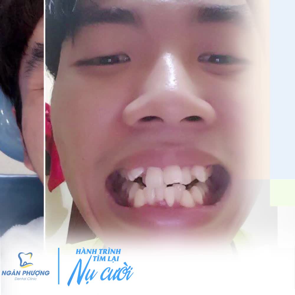 NIỀNG RĂNG - BÍ KÍP GẶT THÀNH CÔNG