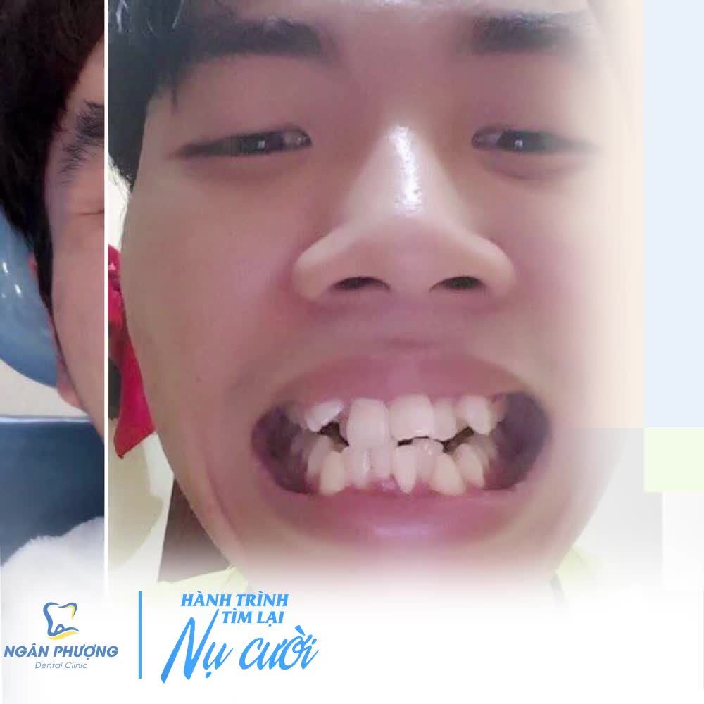 NIỀNG RĂNG - BÍ KÍP GẶT THÀNH CÔNG