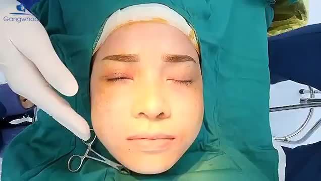 SO SÁNH KẾT QUẢ SAU KHI THỰC HIỆN TIỂU PHẪU LOẠI BỎ MỠ MÁ, MẶT THON XINH XẮN THẤY RÕ