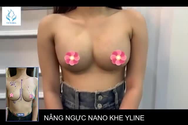 TÁI KHÁM CUỐI NGÀY! NGỰC CĂNG TRÒN TỰ NHIÊN CHỈ SAU 12 NGÀY