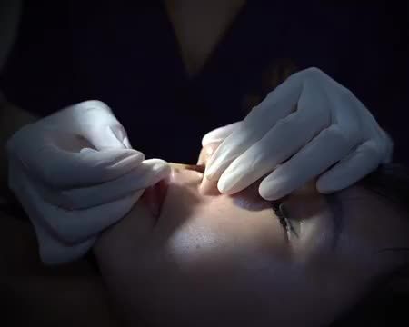 Nâng mũi bao lâu thì cắt chỉ? Cắt chỉ có đau không? Cùng Dr.Hải Lê theo dõi cận cảnh từ A tới Z một ca cắt chỉ nâng mũi Demi 5D đẹp hoàn hảo mọi góc độ.