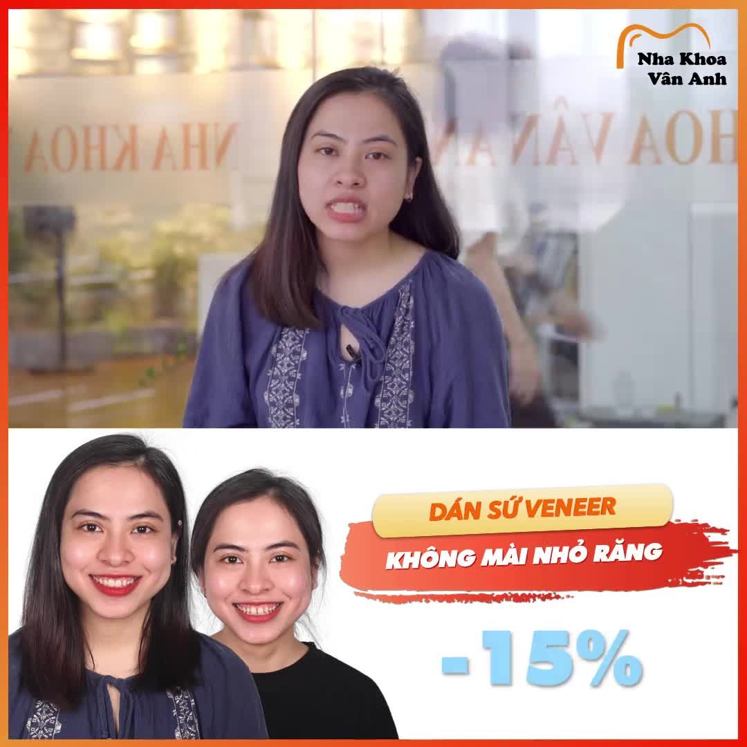 CẢM NHẬN KHÁCH HÀNG SAU KHI DÁN SỨ VENEER - CẢI THIỆN RĂNG THƯA