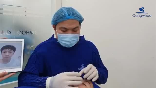 CẮT CÁNH MŨI PHONG THỦY VỪA THỰC HIỆN XONG - KHÔNG ĐAU KHÔNG SƯNG