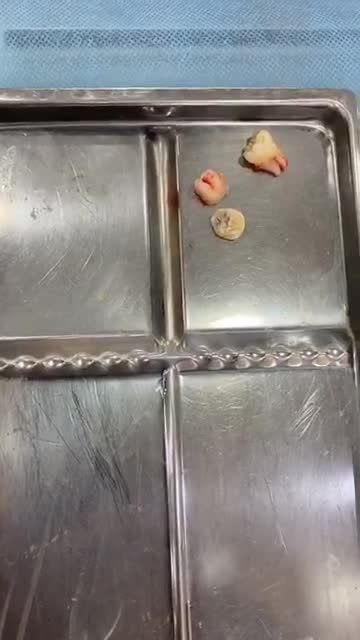 Nhổ 2 răng 8 mọc lệch đâm răng số 7 trong 10 phút. Nhổ răng không đau là có thật