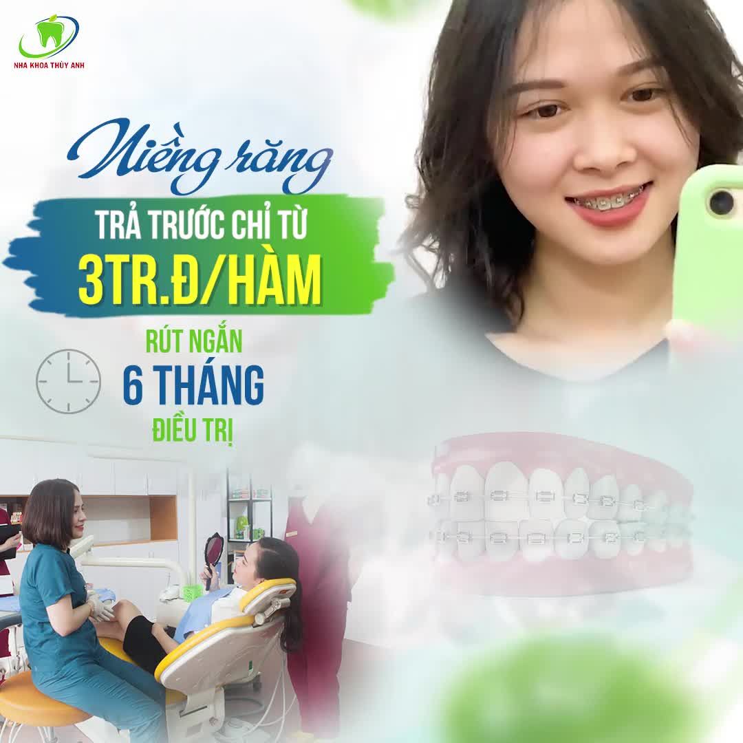 NIỀNG RĂNG TRẢ TRƯỚC CHỈ TỪ 3TR.Đ/HÀM