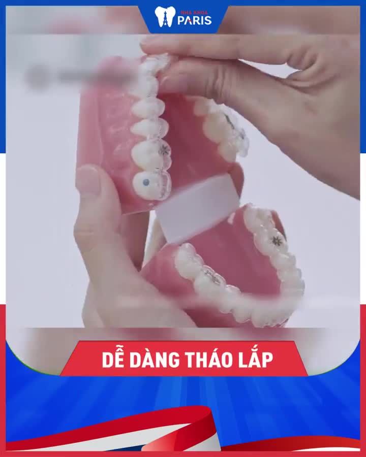 Răng lệch lạc  Niềng răng thế nào để KHÔNG AI BIẾT?