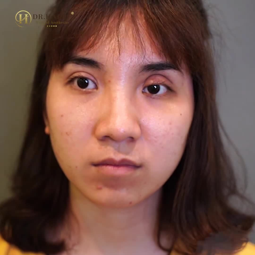 "GIẢI CỨU" 1 CA MÍ BIẾN CHỨNG MÍ HỎNG TẠI DR.HẢI LÊ !