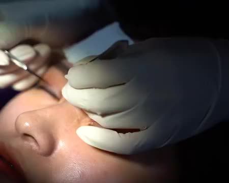 CẮT MÍ SAU 7 NGÀY NẾP MÍ ĐẸP TỰ NHIÊN. BẠN SẼ TIẾC "HÙI HỤI" KHI BỎ QUA VIDEO NÀY! ĐÓN CHỜ SỰ THAY ĐỔI CÙNG DR.HẢI LÊ NHÉ!