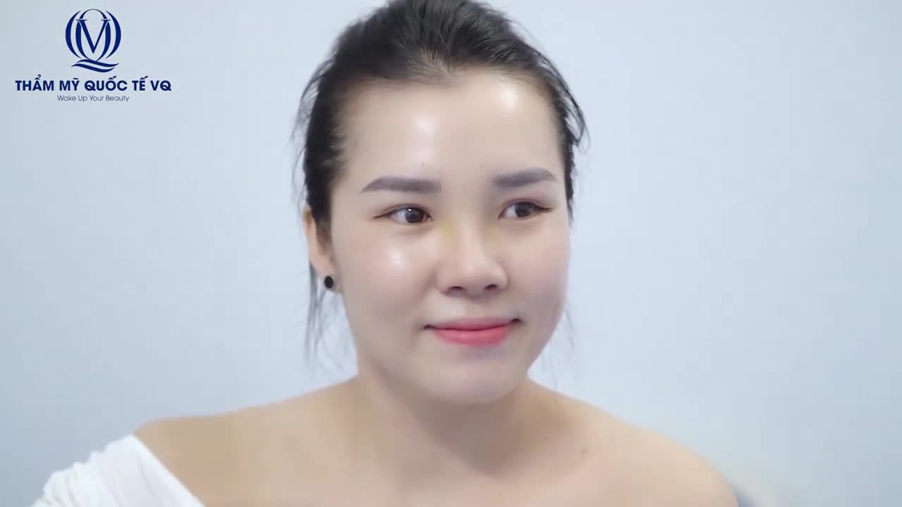 10 ngày sau NÂNG MŨI SOFTLINE - Nữ khách hàng xinh đẹp, rạng ngời.