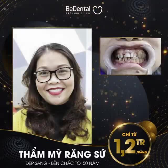 2 NGÀY khắc phục mọi khuyết điểm răng khấp khểnh, hô thưa, hình thể xấu...