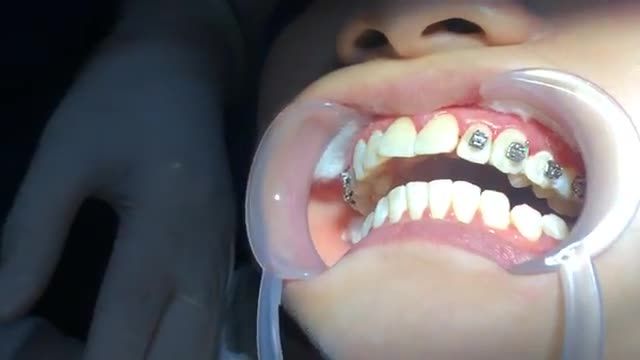 Bác sĩ Vân Anh GẮN MẮC CÀI cho răng HÔ tại Nha Khoa Vân Anh !!! CẮN SÂU + KHẤP KHỂNH