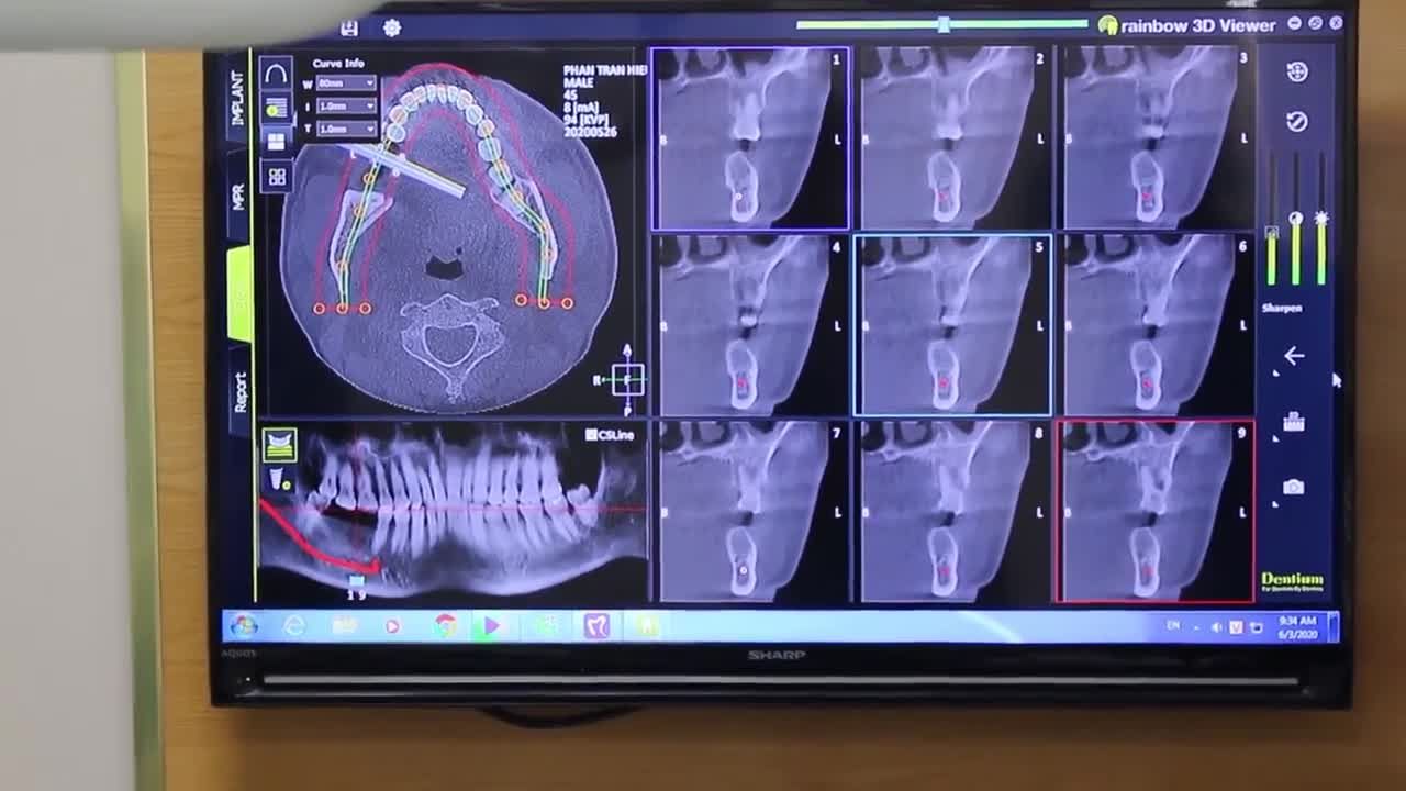 Cấy ghép ca implant r46, r47 cho bệnh nhân N.T.N 41 tuổi đến từ Yên Bái