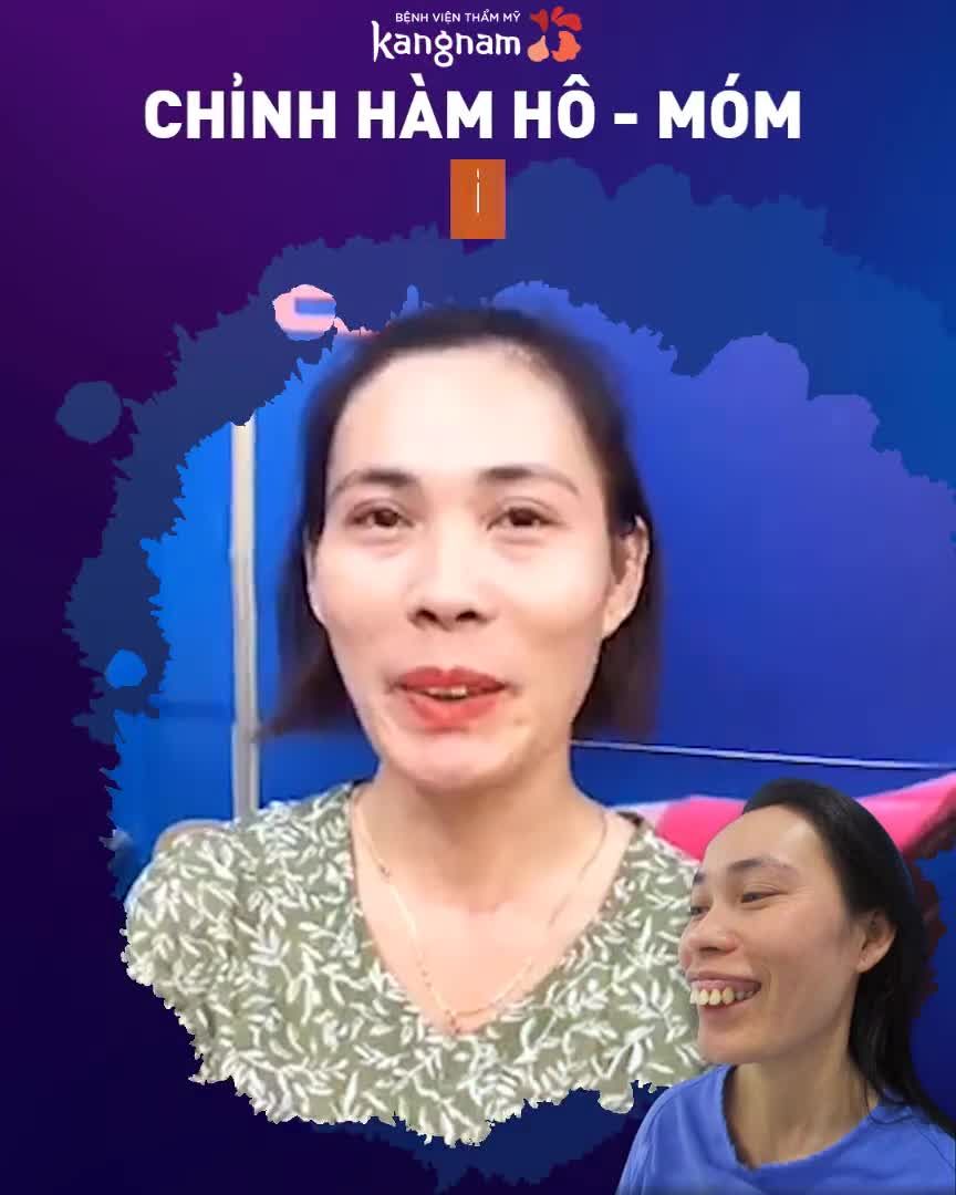 CHỈNH HÌNH HÀM MẶT Cập nhật ngay ưu đãi chào hè