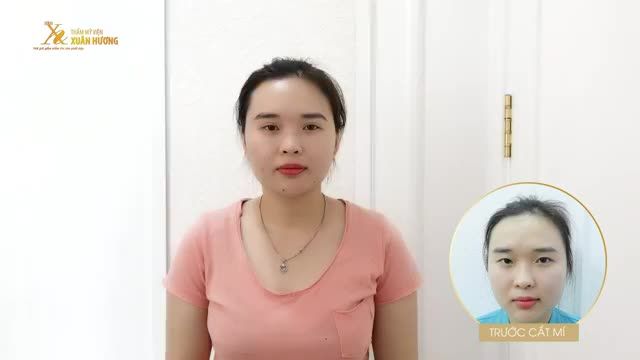 KHÁCH HÀNG ĐẾN TÁI KHÁM SAU 1 THÁNG CẮT MÍ MINIDEEP, KẾT QUẢ HOÀN TOÀN TỰ NHIÊN, NẾP MÍ SẮC NÉT