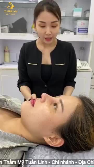Nâng mũi siêu cấu trúc Surgiform tái khám sau 10 ngày
