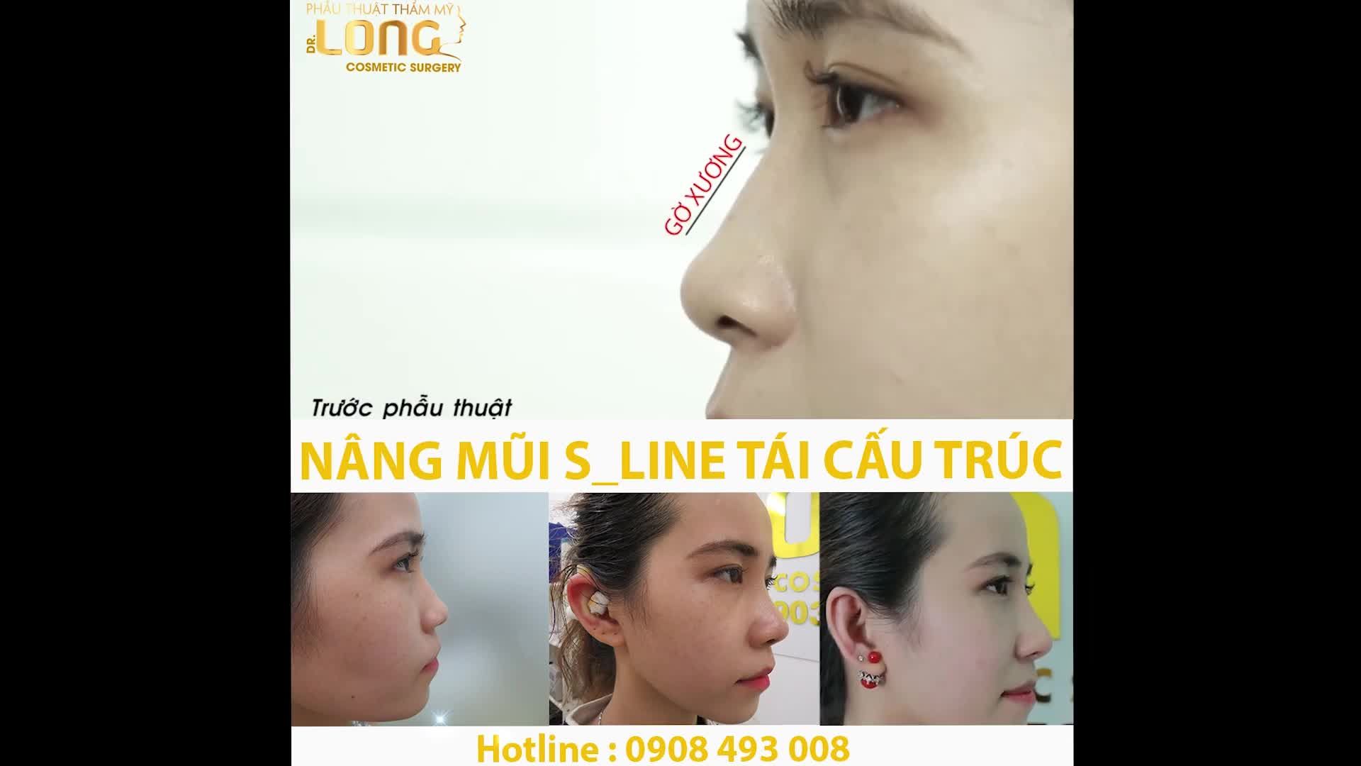 Nâng Mũi Sline Tái Cấu Trúc - Hoàn hảo từ mọi góc nhìn