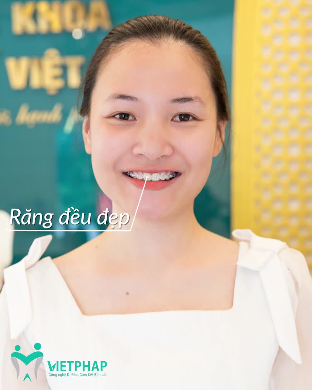 NGỠ NGÀNG TRƯỚC SỰ THAY ĐỔI ĐẾN BẤT NGỜ SAU KHI NIỀNG RĂNG MẮC CÀI