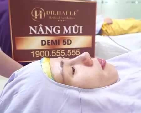 Dáng mũi DEMI 5D hoàn hảo! Ở góc độ khách hàng đang nằm càng thấy rõ kết quả nâng mũi tuyệt vời phải không các bạn?