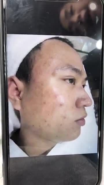 Điều trị mụn viêm sau bao nhiêu buổi thì khỏi? KH nam trị dứt điểm mụn viêm sau 1 liệu trình