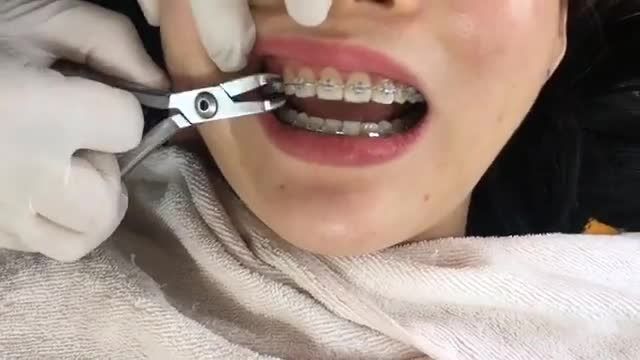 BUNG LỤA CHO KHÁCH HÀNG RĂNG HÔ - KHẤP KHỂNH