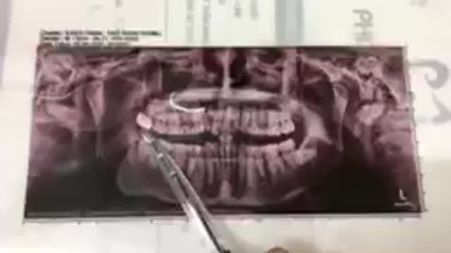 Nhổ răng khôn lợi trùm đau nhức cho chú Vượng