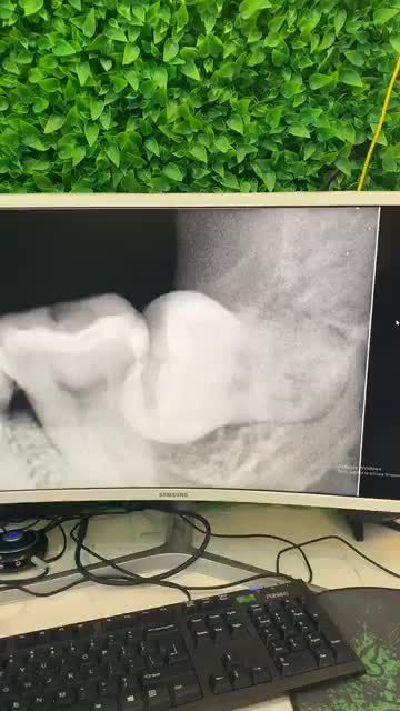 Răng số 8 chân răng to, phức tạp xử lý trong 10 phút