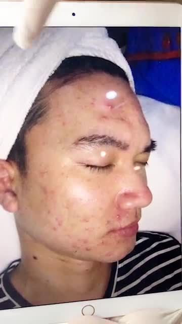 Kết quả ngoạn mục sau khi ĐIỀU TRỊ MỤN NANOSKIN
