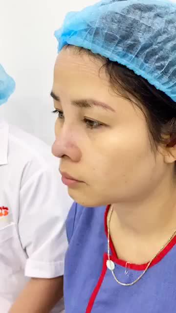 Kết quả ĐẸP ngoạn mục ngay sau khi nâng mũi Cấu Trúc 4D tại Bệnh viện thẩm mỹ Kangnam