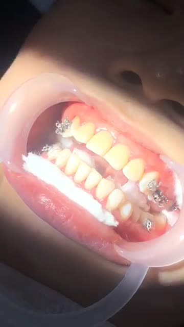 Bác sĩ Vân Anh gắn mắc cài điều trị cho răng hô