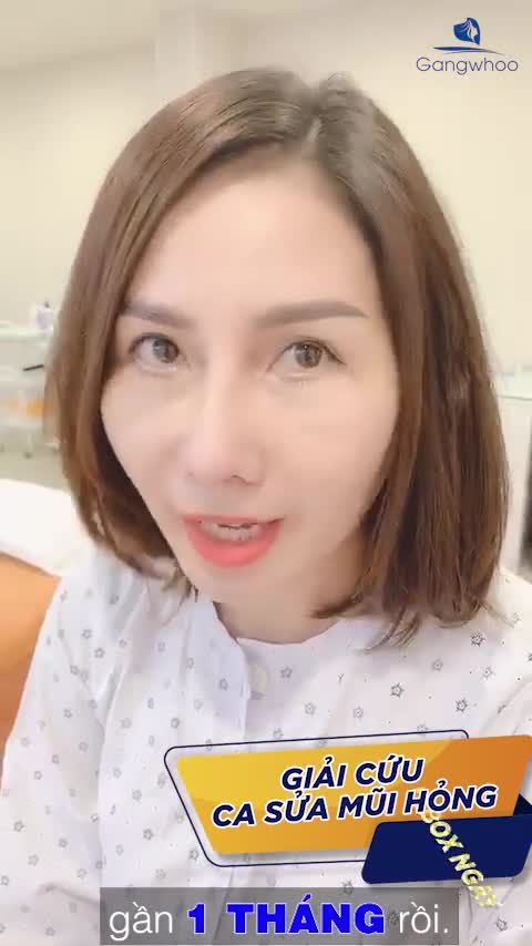 BẤT NGỜ VỚI KẾT QUẢ NÂNG MŨI SAU 1 THÁNG CỦA CHỊ KHÁCH HÀNG SỬA MŨI HỎNG 2 LẦN TRONG 29 NĂM