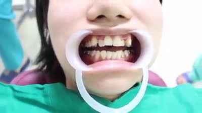 ĐIỂM NỔI BẬT KHI NIỀNG RĂNG MẮC CÀI KIM LOẠI TẠI TRUNG TÂM NHA KHOA HÀ NỘI- SYDNEY