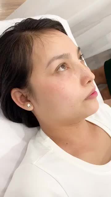 MŨI CẤU TRÚC SAU 10 NGÀY SẼ NHƯ THẾ NÀO?