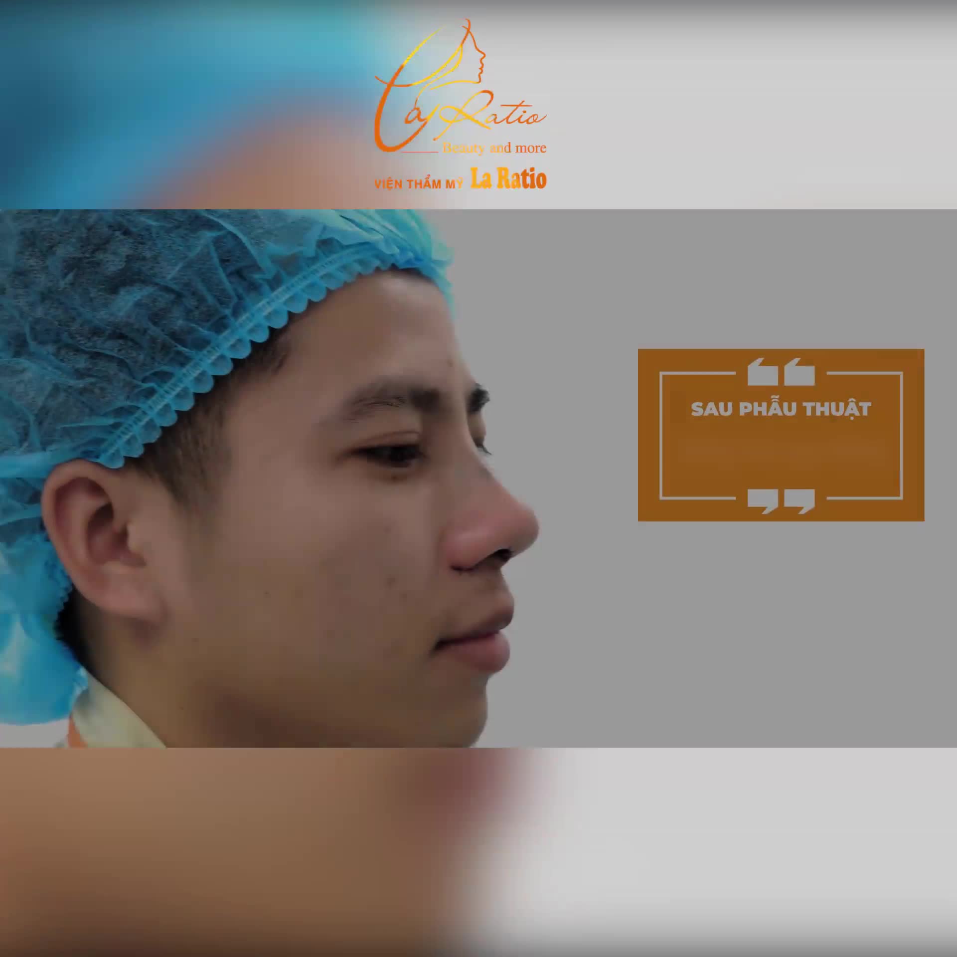 NÂNG MŨI MEGA S CHO PHÁI MẠNH – ĐẸP NHƯNG VẪN PHẢI “MEN”