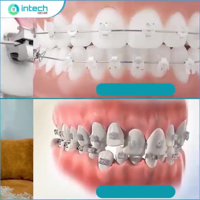 NIỀNG RĂNG MẮC CÀI TỰ ĐỘNG – RÚT NGẮN THỜI GIAN ĐIỀU TRỊ LÊN TỚI 8 THÁNG