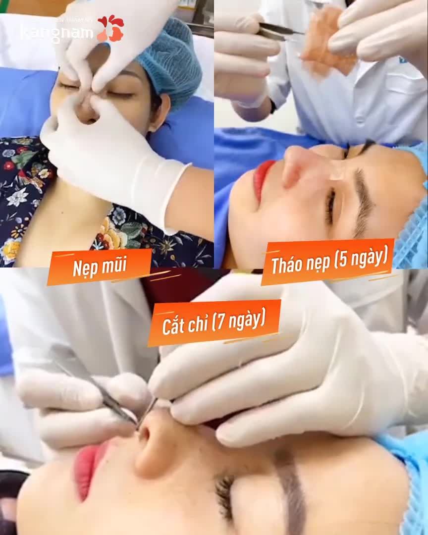 Đây là 6 BƯỚC NÂNG MŨI "CHUẨN" - Yên trí mũi đẹp bền vững
