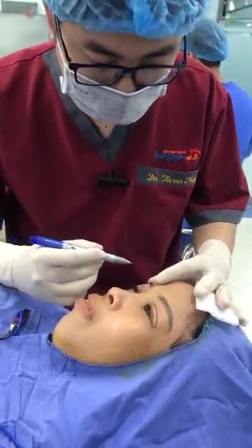 Đo vẽ thiết kế nếp mí Bước tiến hành đầu tiên trong phẫu thuật cắt mí Plasma tại Kangnam