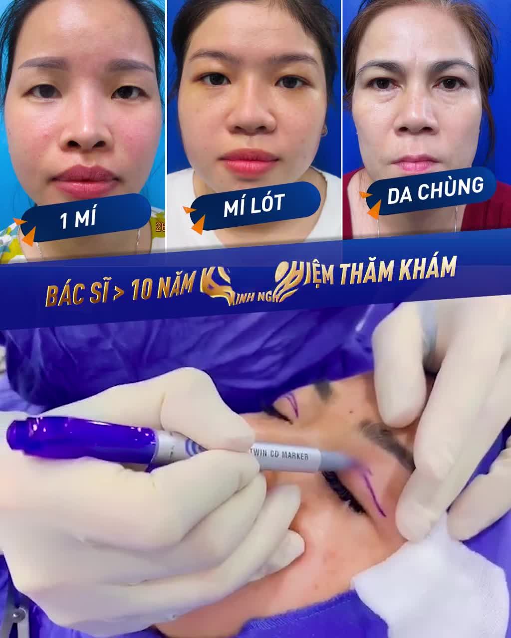 Cắt mí Plasma - Kiến tạo MÍ ĐẸP sau 30 phút