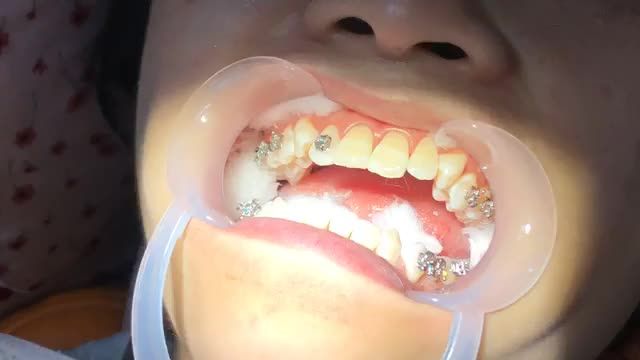 GẮN MẮC CÀI cho răng CẮN NGƯỢC tại Nha Khoa Vân Anh !!!