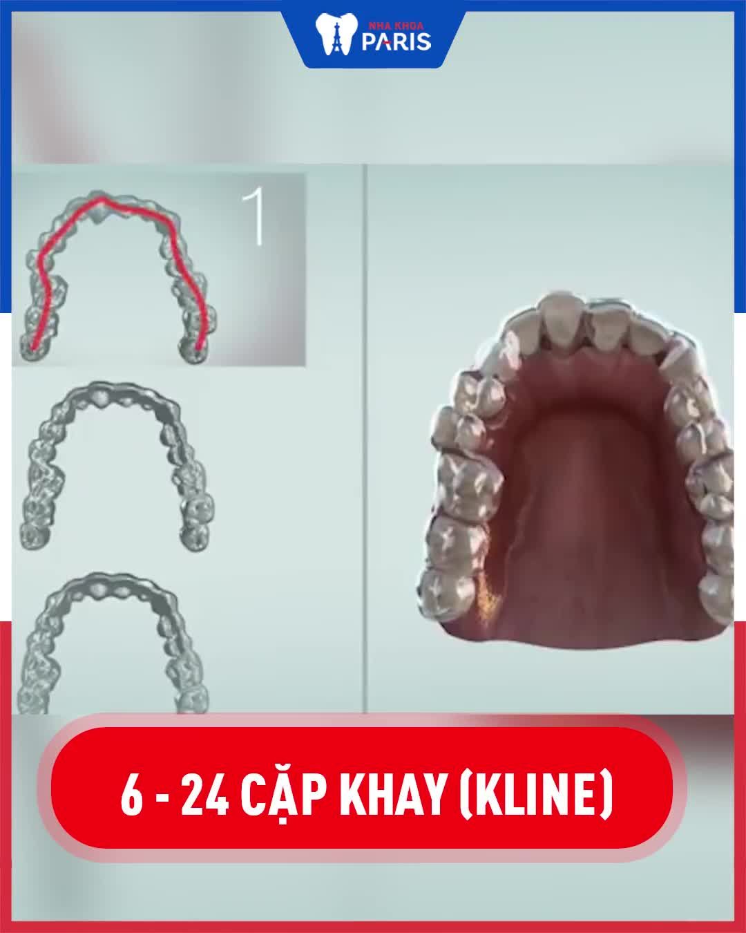 NIỀNG RĂNG KHAY TRONG - NIỀNG VÔ HÌNH KHÔNG AI BIẾT‼